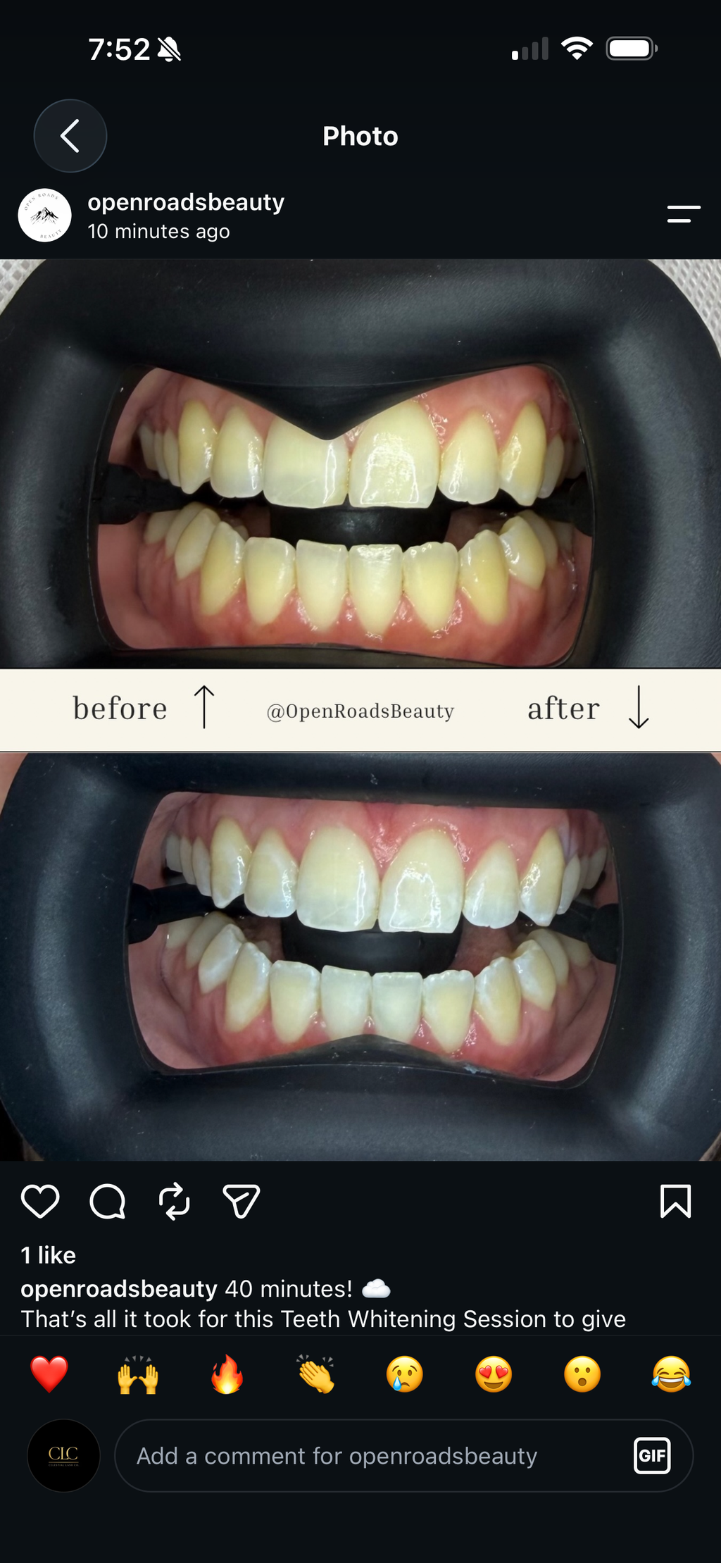 CLC Teeth Whitening Kit