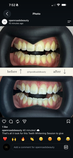 CLC Teeth Whitening Kit