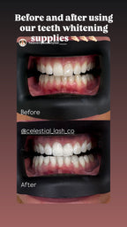 CLC Teeth Whitening Kit